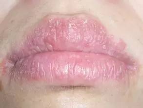唇炎是一种以口唇干燥,皲裂,脱屑为主要临床表现的粘膜病,根据