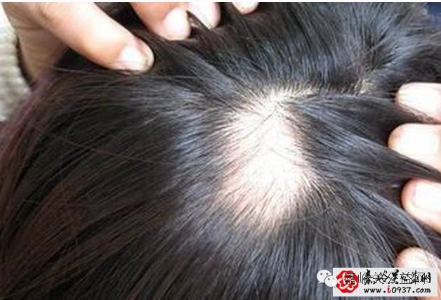 酒泉11岁女孩脱发在兰州某医院治疗后变秃顶🔴美女模仿“电钻吃玉米”被卷掉头发