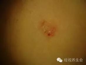 一巴掌下去想拍虫子,脖子居然发痒溃烂!陈赫也曾经被...