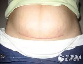 剖腹产要二胎,一定要注意这几点-怀孕期