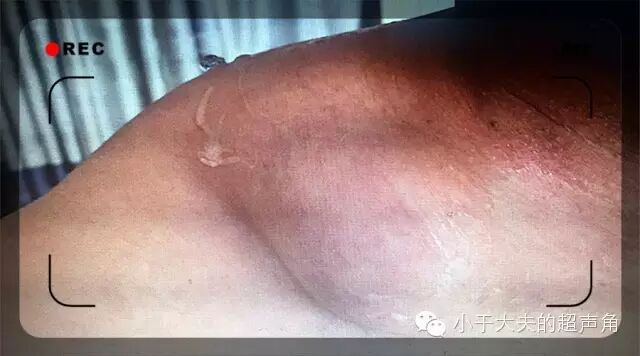 【超声角】★对称分布の浅表肿物★【附两例病例】★马德龙综合征★