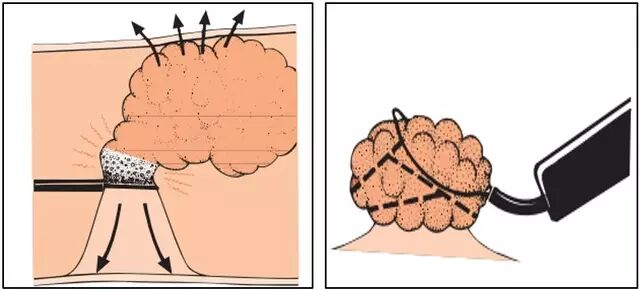 什么是热活检钳图文解析：轻松搞定结肠息肉 7 种切除方法_https://www.jmylbn.com_新闻资讯_第5张