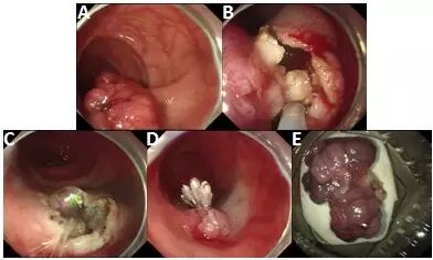 什么是热活检钳图文解析：轻松搞定结肠息肉 7 种切除方法_https://www.jmylbn.com_新闻资讯_第11张