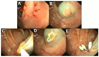 什么是热活检钳图文解析：轻松搞定结肠息肉 7 种切除方法_https://www.jmylbn.com_新闻资讯_第14张