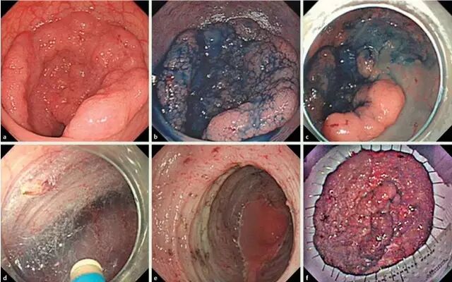 什么是热活检钳图文解析：轻松搞定结肠息肉 7 种切除方法_https://www.jmylbn.com_新闻资讯_第16张