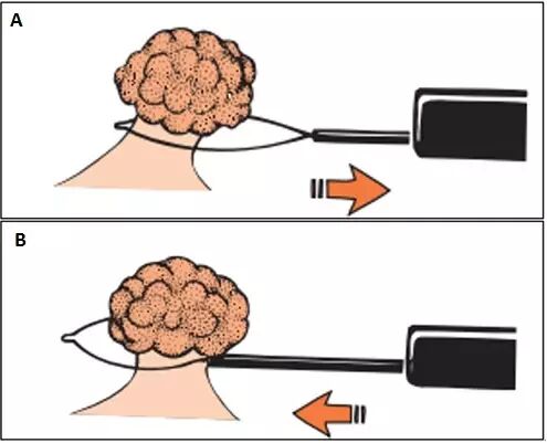 什么是热活检钳图文解析：轻松搞定结肠息肉 7 种切除方法_https://www.jmylbn.com_新闻资讯_第3张