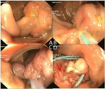 什么是热活检钳图文解析：轻松搞定结肠息肉 7 种切除方法_https://www.jmylbn.com_新闻资讯_第7张