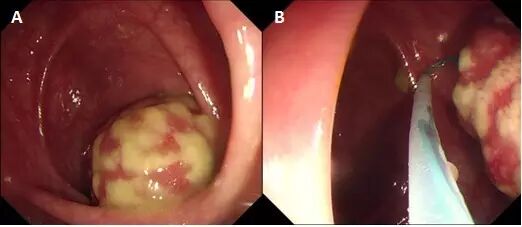 什么是热活检钳图文解析：轻松搞定结肠息肉 7 种切除方法_https://www.jmylbn.com_新闻资讯_第18张