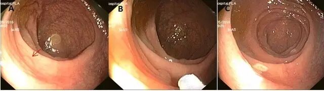 什么是热活检钳图文解析：轻松搞定结肠息肉 7 种切除方法_https://www.jmylbn.com_新闻资讯_第21张