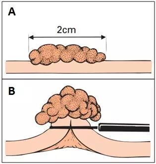 什么是热活检钳图文解析：轻松搞定结肠息肉 7 种切除方法_https://www.jmylbn.com_新闻资讯_第12张
