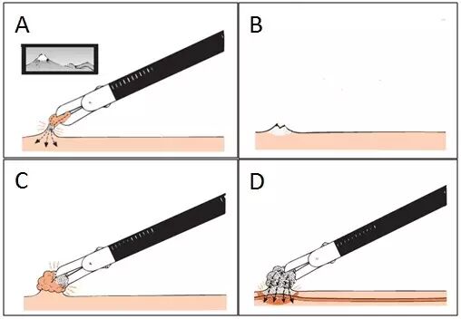 什么是热活检钳图文解析：轻松搞定结肠息肉 7 种切除方法_https://www.jmylbn.com_新闻资讯_第1张