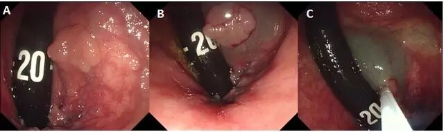 什么是热活检钳图文解析：轻松搞定结肠息肉 7 种切除方法_https://www.jmylbn.com_新闻资讯_第23张
