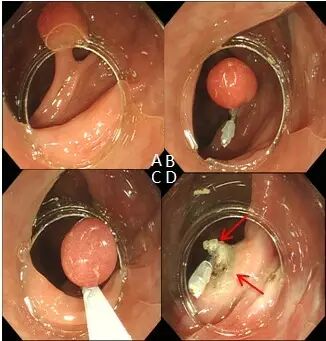 什么是热活检钳图文解析：轻松搞定结肠息肉 7 种切除方法_https://www.jmylbn.com_新闻资讯_第8张