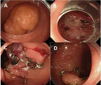 什么是热活检钳图文解析：轻松搞定结肠息肉 7 种切除方法_https://www.jmylbn.com_新闻资讯_第17张
