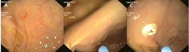 什么是热活检钳图文解析：轻松搞定结肠息肉 7 种切除方法_https://www.jmylbn.com_新闻资讯_第20张