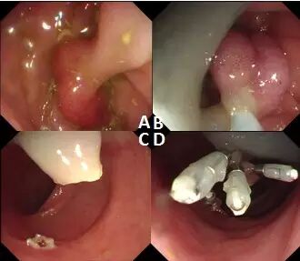 什么是热活检钳图文解析：轻松搞定结肠息肉 7 种切除方法_https://www.jmylbn.com_新闻资讯_第9张