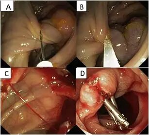 什么是热活检钳图文解析：轻松搞定结肠息肉 7 种切除方法_https://www.jmylbn.com_新闻资讯_第10张