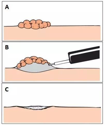 什么是热活检钳图文解析：轻松搞定结肠息肉 7 种切除方法_https://www.jmylbn.com_新闻资讯_第13张