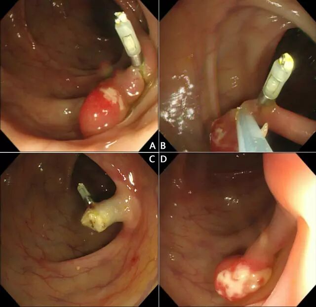 什么是热活检钳图文解析：轻松搞定结肠息肉 7 种切除方法_https://www.jmylbn.com_新闻资讯_第6张