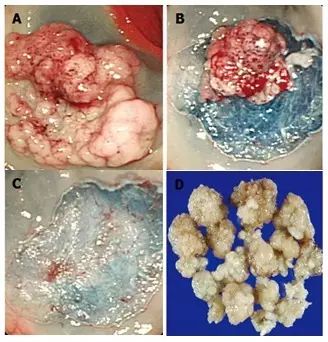 图文详解:结肠息肉切除术