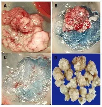 什么是热活检钳图文解析：轻松搞定结肠息肉 7 种切除方法_https://www.jmylbn.com_新闻资讯_第15张