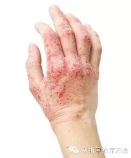 怎么辨别手足癣和手足湿疹？