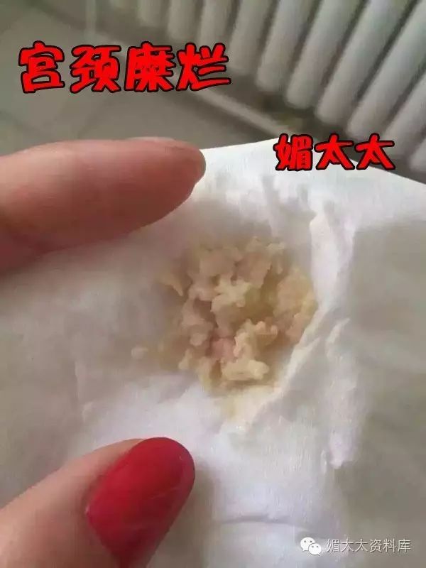 5,排出的瘀毒是毛肚状,有可能是子宫内膜炎,盆腔炎.