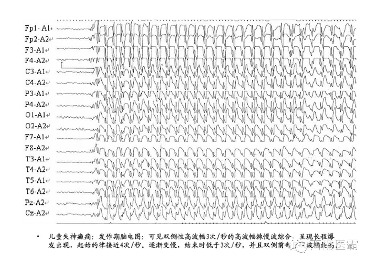 这两张图都是脑电图,第一张是正常脑电图,第二张是异常脑电图.