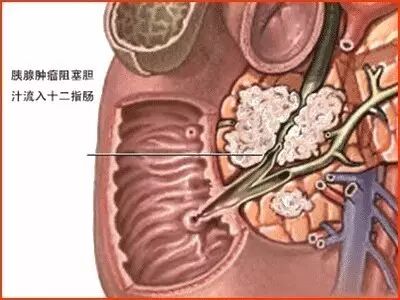 胰腺癌因何“偏爱”名人