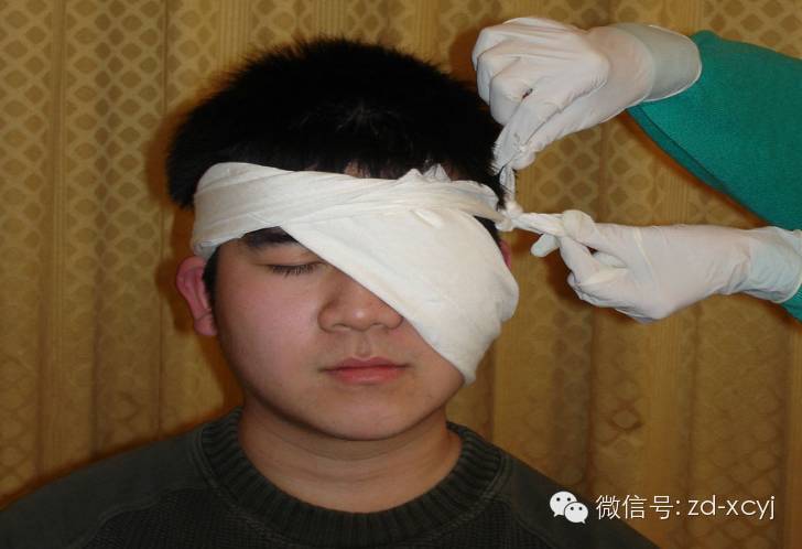 单眼包扎:适用于一侧眼部外伤的伤员,检查伤口,无异物,盖上敷料.