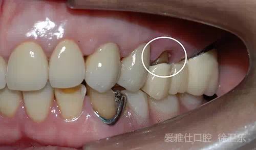 真实案例让你了解假牙是如何制作的