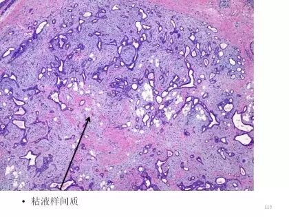 于励民讲课笔记 | 汗腺肿瘤之大汗腺良性瘤