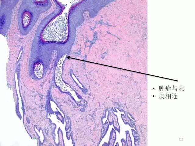 于励民讲课笔记 | 汗腺肿瘤之大汗腺良性瘤
