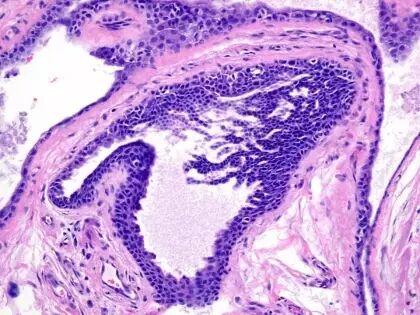 于励民讲课笔记 | 汗腺肿瘤之大汗腺良性瘤