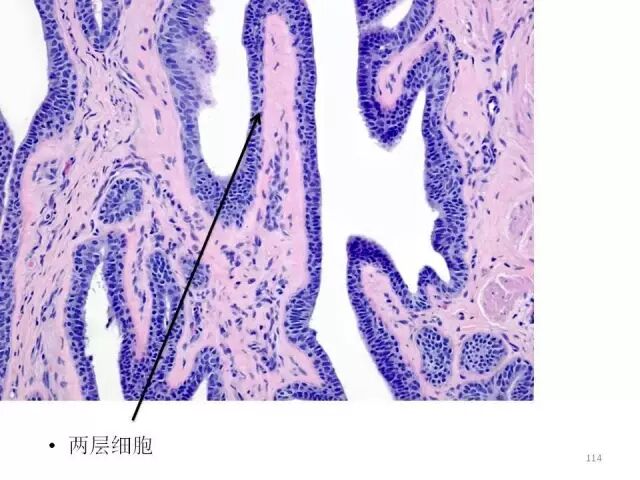 于励民讲课笔记 | 汗腺肿瘤之大汗腺良性瘤