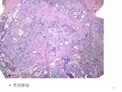 于励民讲课笔记 | 汗腺肿瘤之大汗腺良性瘤