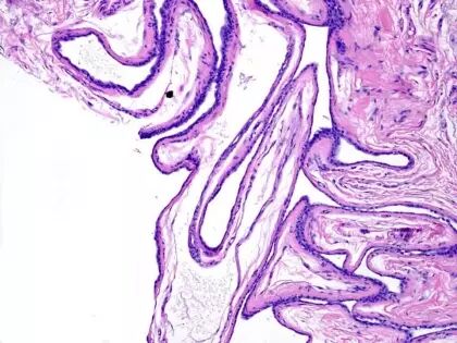 于励民讲课笔记 | 汗腺肿瘤之大汗腺良性瘤