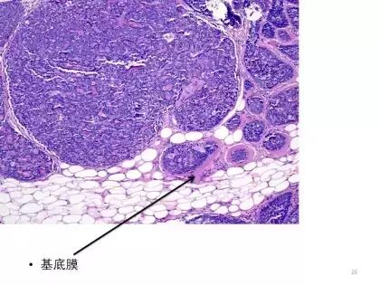 于励民讲课笔记 | 汗腺肿瘤之大汗腺良性瘤