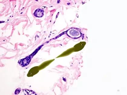 于励民讲课笔记 | 汗腺肿瘤之大汗腺良性瘤