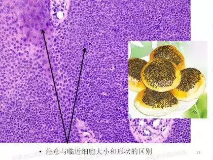 于励民讲课笔记 | 汗腺肿瘤之大汗腺良性瘤