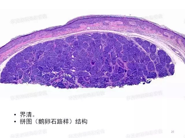 于励民讲课笔记 | 汗腺肿瘤之大汗腺良性瘤