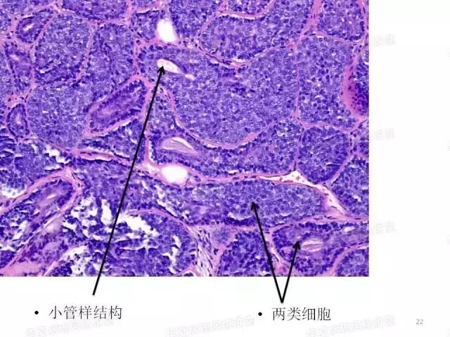 于励民讲课笔记 | 汗腺肿瘤之大汗腺良性瘤