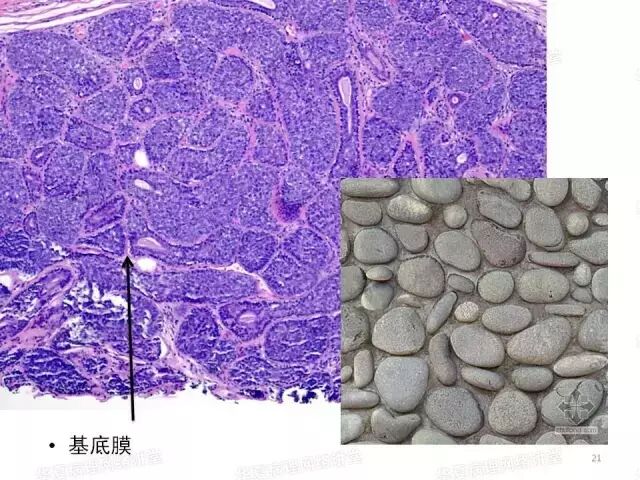 于励民讲课笔记 | 汗腺肿瘤之大汗腺良性瘤