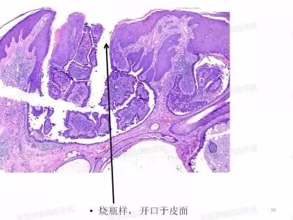 于励民讲课笔记 | 汗腺肿瘤之大汗腺良性瘤