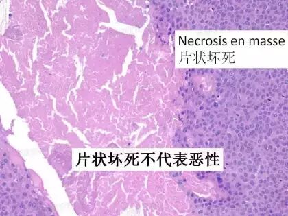 于励民讲课笔记 | 汗腺肿瘤之大汗腺良性瘤