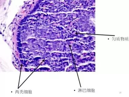 于励民讲课笔记 | 汗腺肿瘤之大汗腺良性瘤