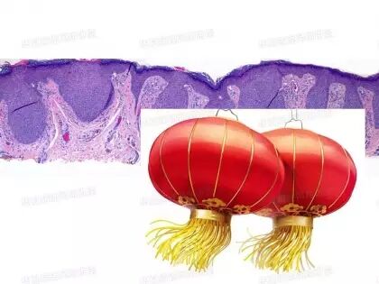 于励民讲课笔记 | 汗腺肿瘤之大汗腺良性瘤