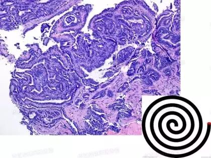 于励民讲课笔记 | 汗腺肿瘤之大汗腺良性瘤