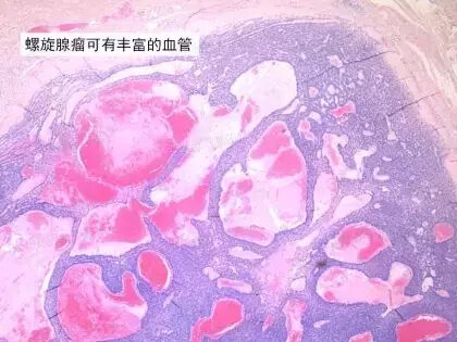 于励民讲课笔记 | 汗腺肿瘤之大汗腺良性瘤