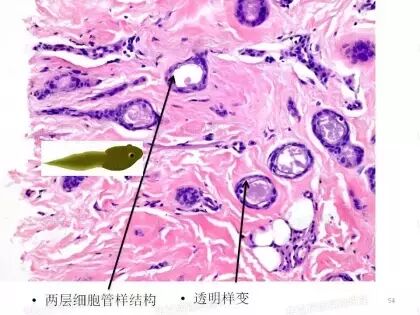 于励民讲课笔记 | 汗腺肿瘤之大汗腺良性瘤